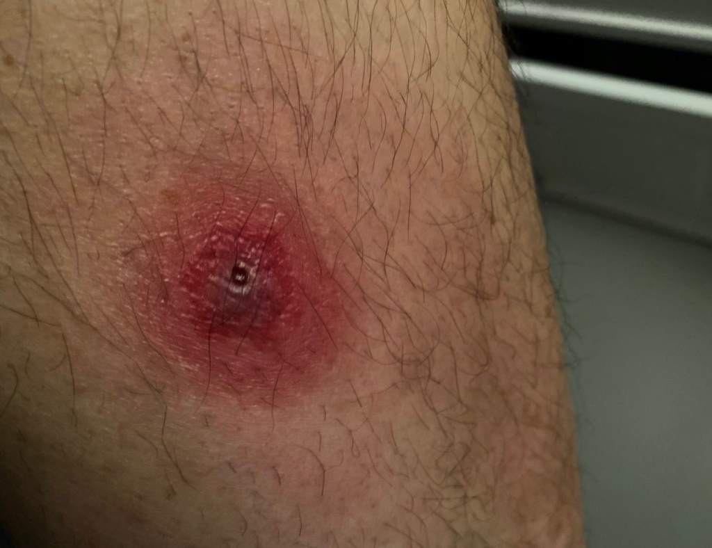 Brown Recluse Spider bites